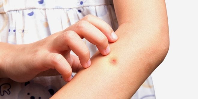Six Common Children S Skin Rashes In Japan Heat Virus Or Bug